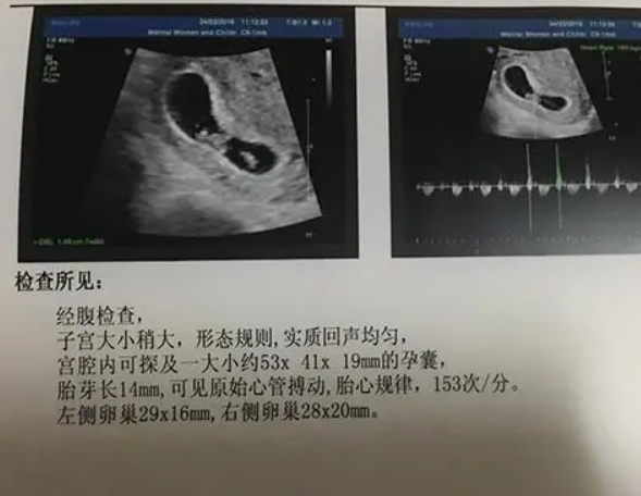 孕囊大小不能反映胎儿性别