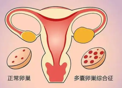 多囊卵巢综合症诊断标准和治疗.png