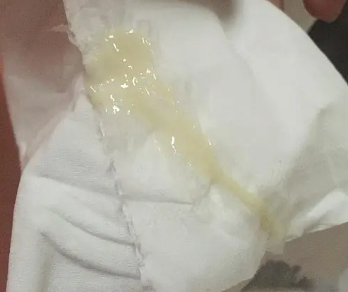 孕期感染易导致白带发黄