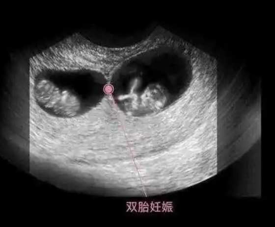 2个卵泡排出怀双胎几率不大