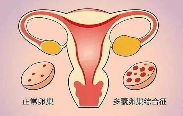 多囊女性直接做一代试管对身体有害