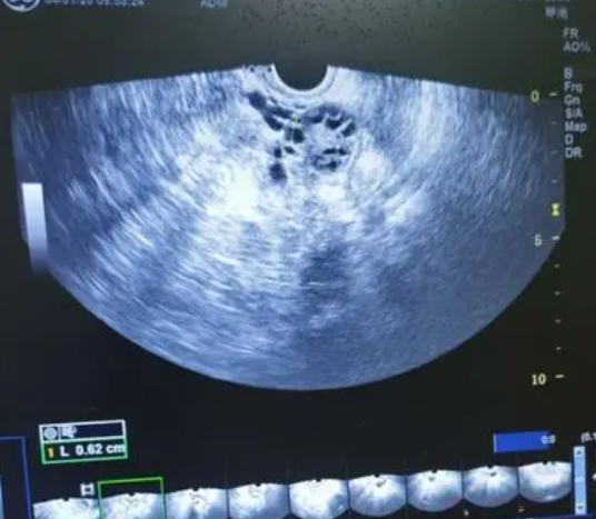 卵泡18mm随时会排卵