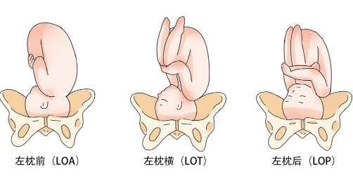 lop胎位是不是很难入盆.png