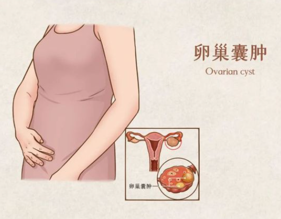 卵巢囊肿会影响排卵