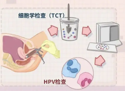 宫颈癌检测项目是不是很多，有必要每年都做吗