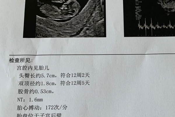 移植后第12周可做nt检查