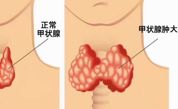 甲状腺左侧囊肿不影响试管