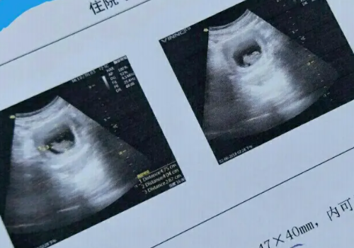 孕囊大小因人而异