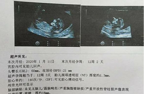 通过孕囊看男女不科学