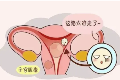 子宫肌瘤的早期症状有哪些1.png