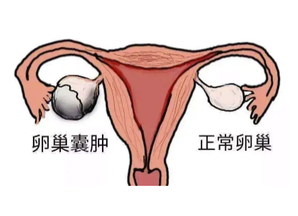 卵巢囊肿多久会癌变1.png