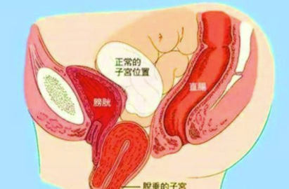 子宫下垂.png