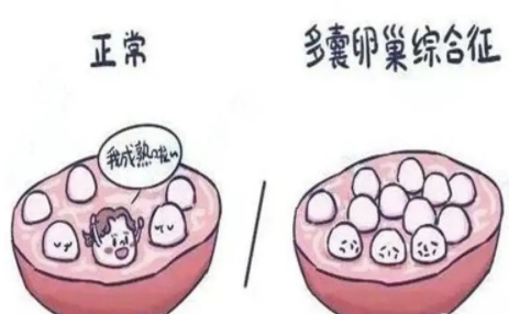 多囊卵巢综合症.png