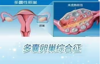 多囊卵巢综合症有什么危害.png