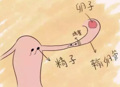 输卵管不通的治疗方法.png