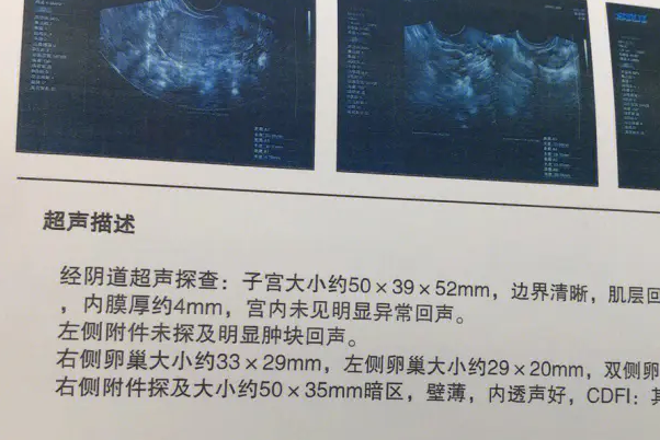 卵巢早衰会导致一侧有16个卵泡