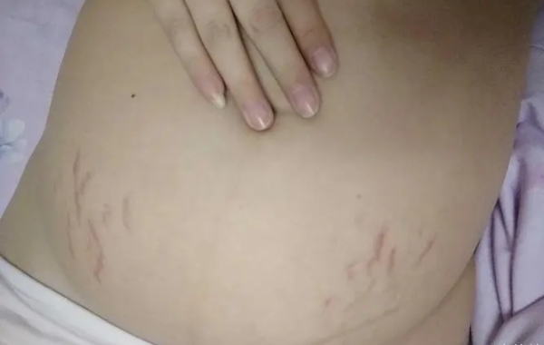 两种妊娠纹没有哪一种更严重的研究证明
