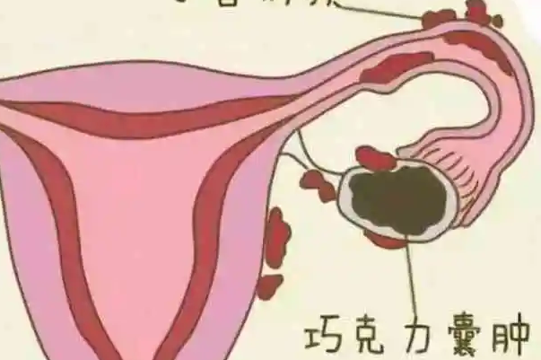 巧克力囊肿会增加感染风险
