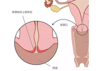 轻度宫颈糜烂需要治疗吗，不治的话会自愈吗