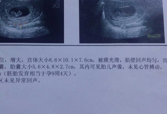 胎停育的报告