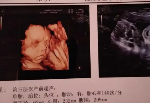 胎儿面容不能辨男女