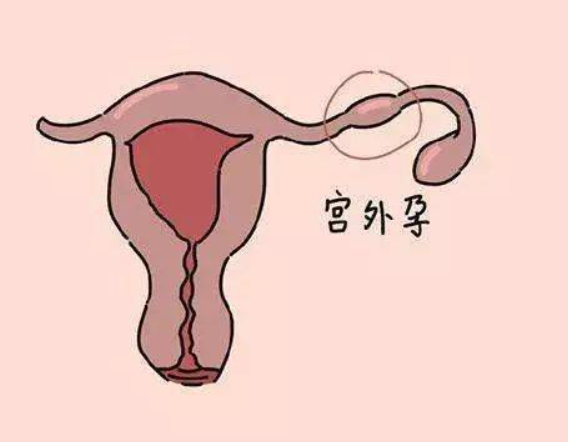 试管宫外孕比自然怀孕要高