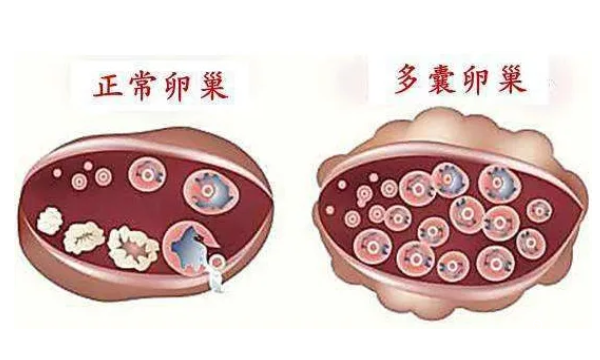 多囊加输卵管通而不畅