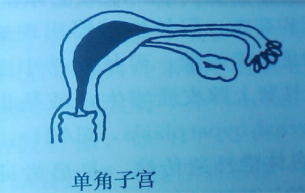 高龄单角子宫试管移植