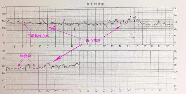 胎心监护标准图