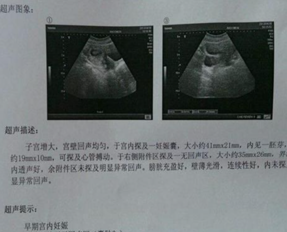35天胚胎已经着床