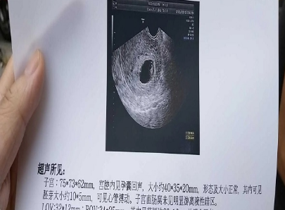 孕囊在孕初期增长快