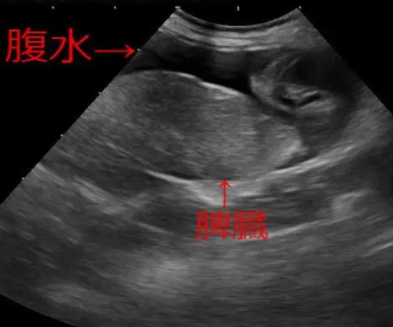 腹水能通过穿刺治疗
