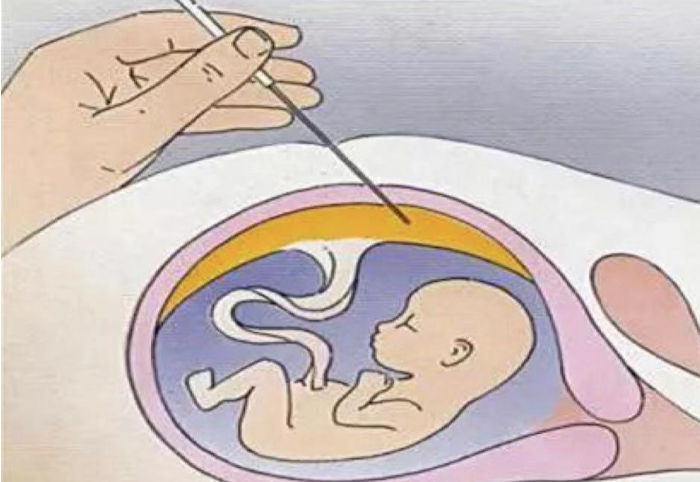 羊水穿刺结果正常仍会生下畸形儿