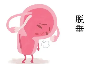 子宫下垂1.png