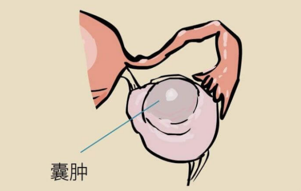 巧囊术后半年不孕可以试管