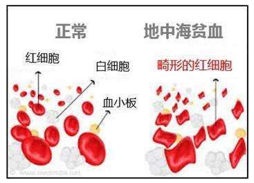 地中海贫血