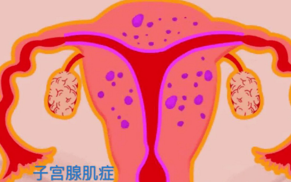 子宫腺肌症是否切除的判断