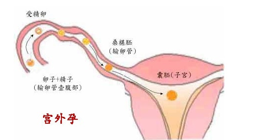 试管婴儿宫外孕.png
