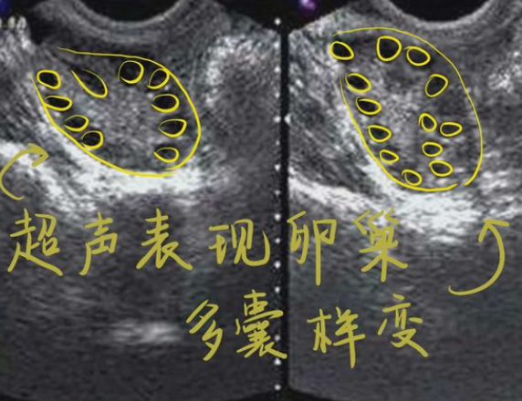 多囊自然怀孕几率小