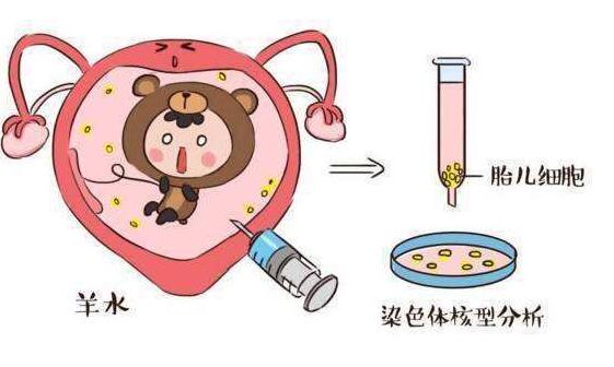 羊水穿刺