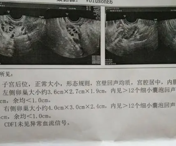 多囊正常排卵会怀孕