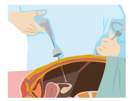 腹腔镜.jpg