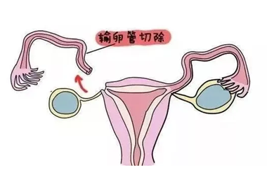 切除一侧输卵管能做试管