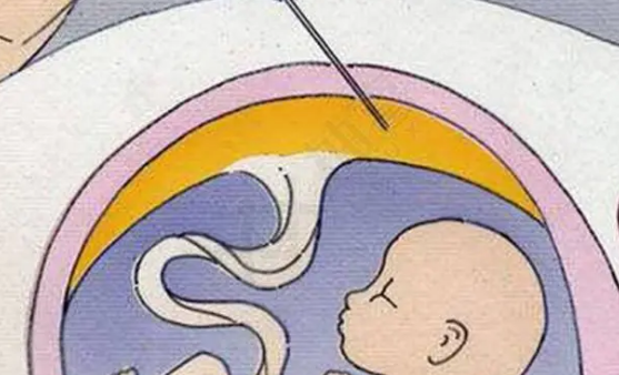 羊水穿刺存在一定的风险