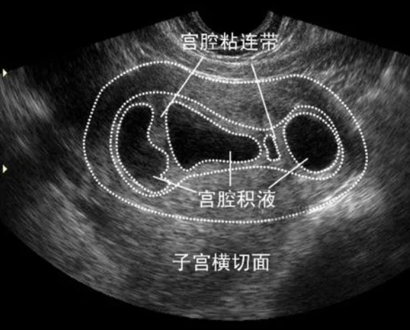 宫腔疾病会影响成功率