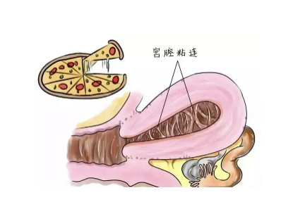宫腔镜后最易粘连时间.png