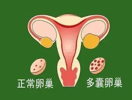 多囊卵巢患者进行试管婴儿，促排卵针的用药时间和剂量有何不同？
