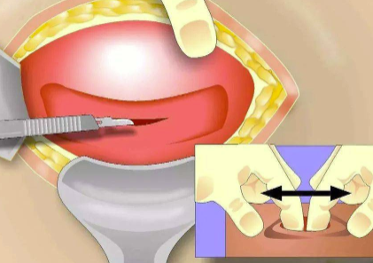 剖腹产9个月怀孕了可以要吗.png