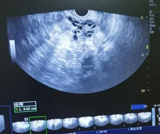 卵泡不长也有可能发育成熟