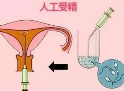 人工授精也要进行诱导排卵